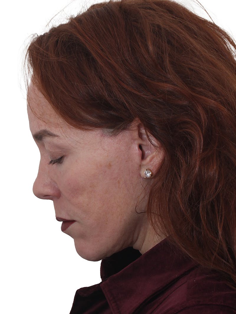 Laser Treatment Before & After Gallery - Patient 241742 - Image 4