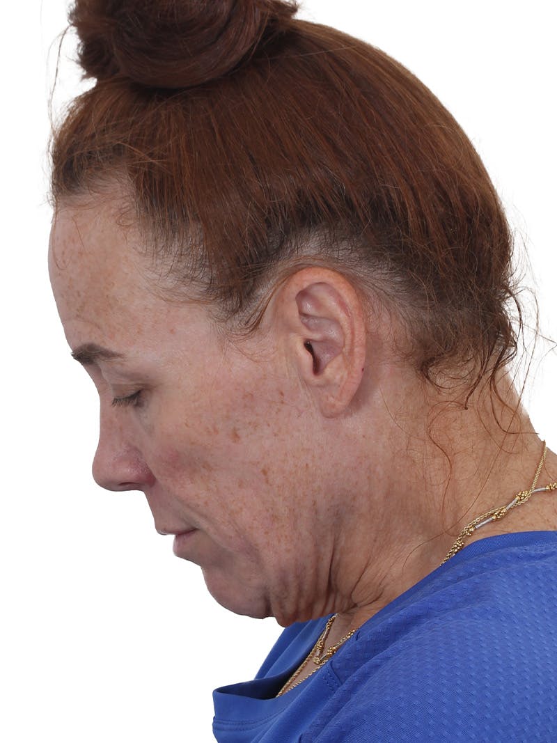 Laser Treatment Before & After Gallery - Patient 241742 - Image 3