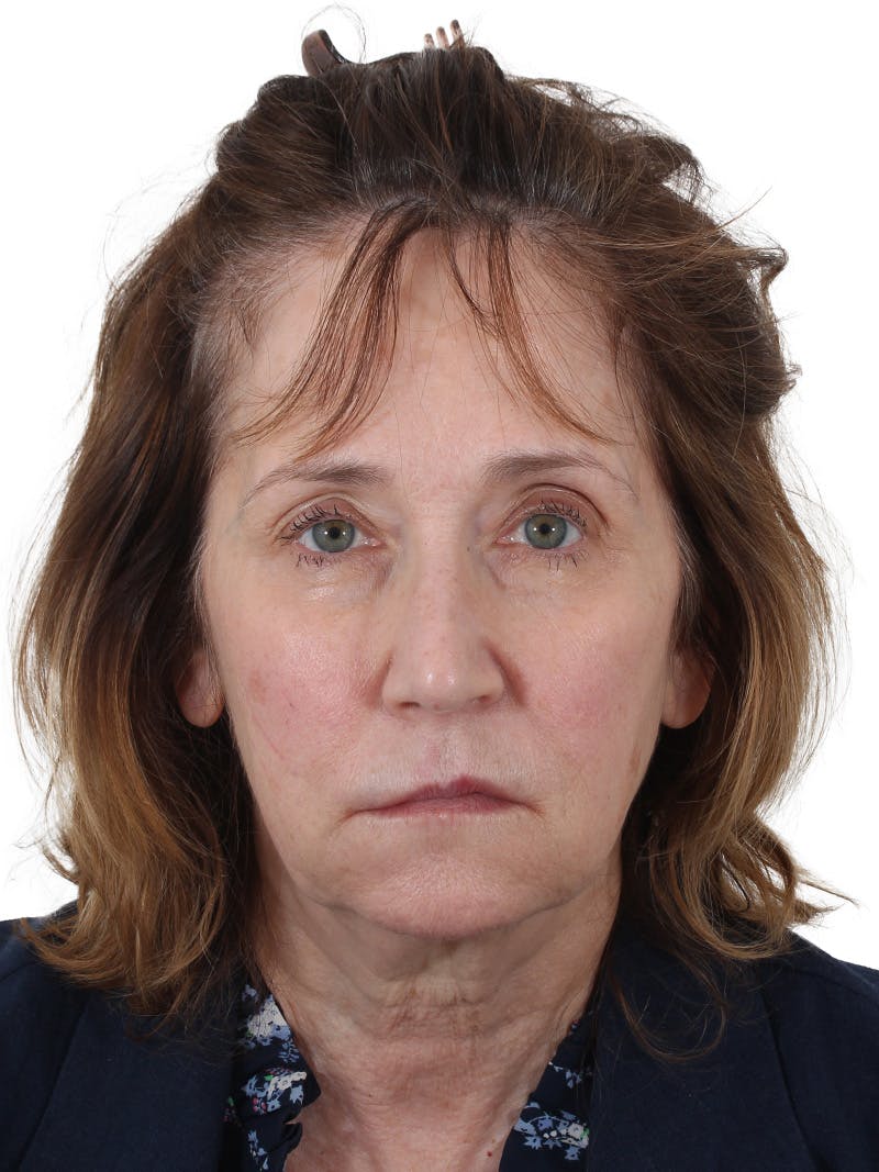 Dr. Frankel's Facelift in Cleveland Before and After 11