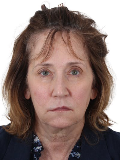 Fat Transfer Before & After Gallery - Patient 322455 - Image 1