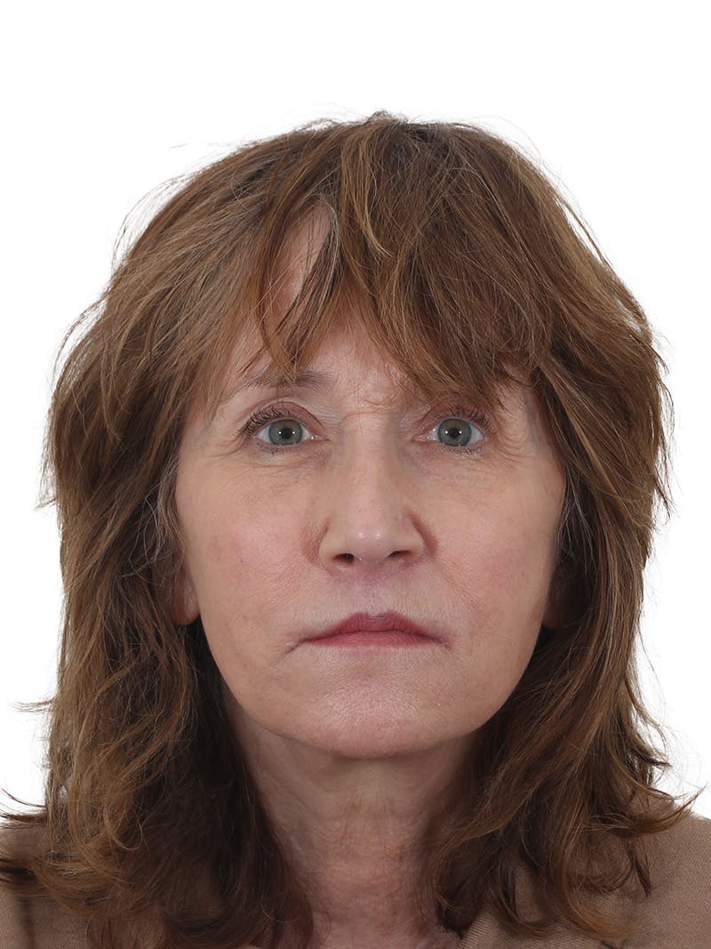 Dr. Frankel's Facelift in Cleveland Before and After 11