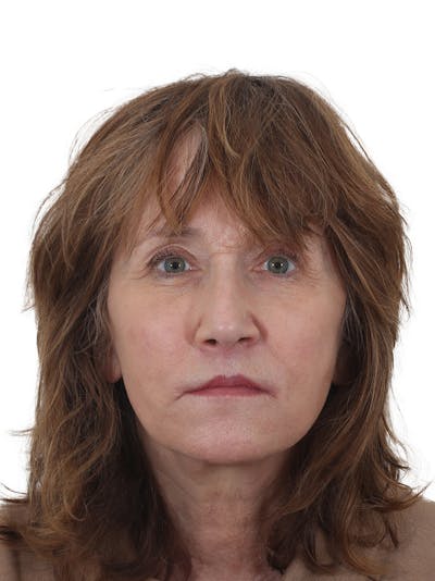 Fat Transfer Before & After Gallery - Patient 322455 - Image 2