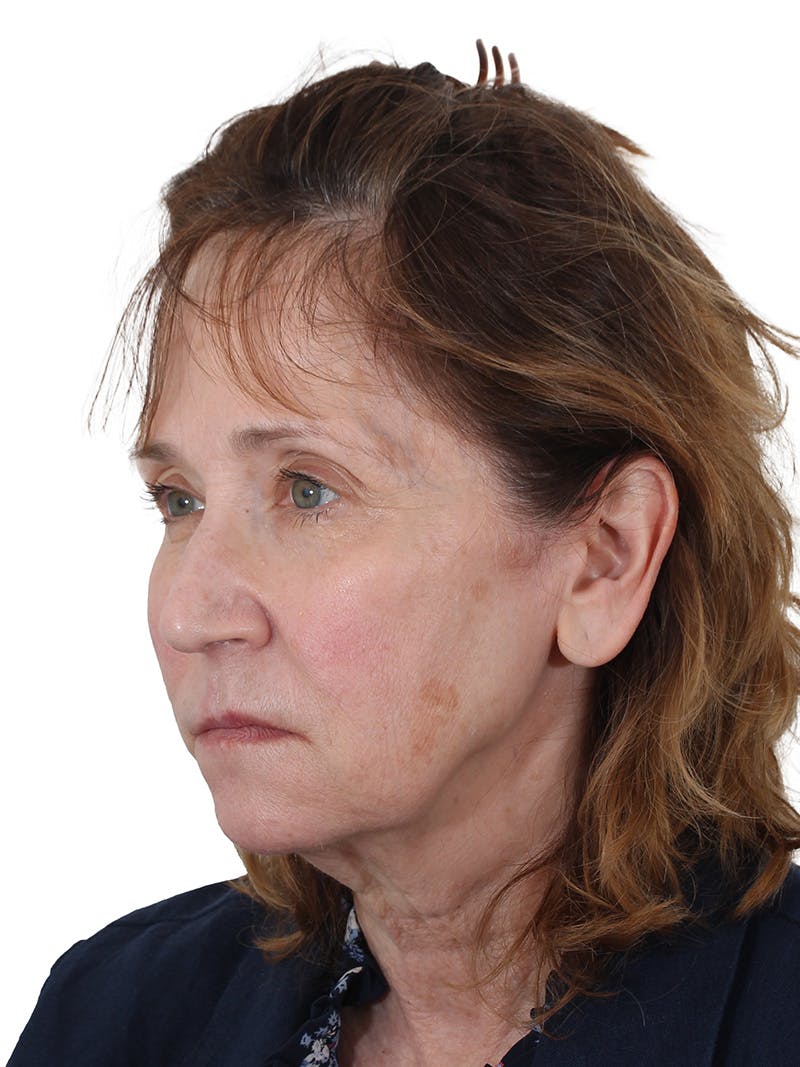 Fat Transfer Before & After Gallery - Patient 322455 - Image 3