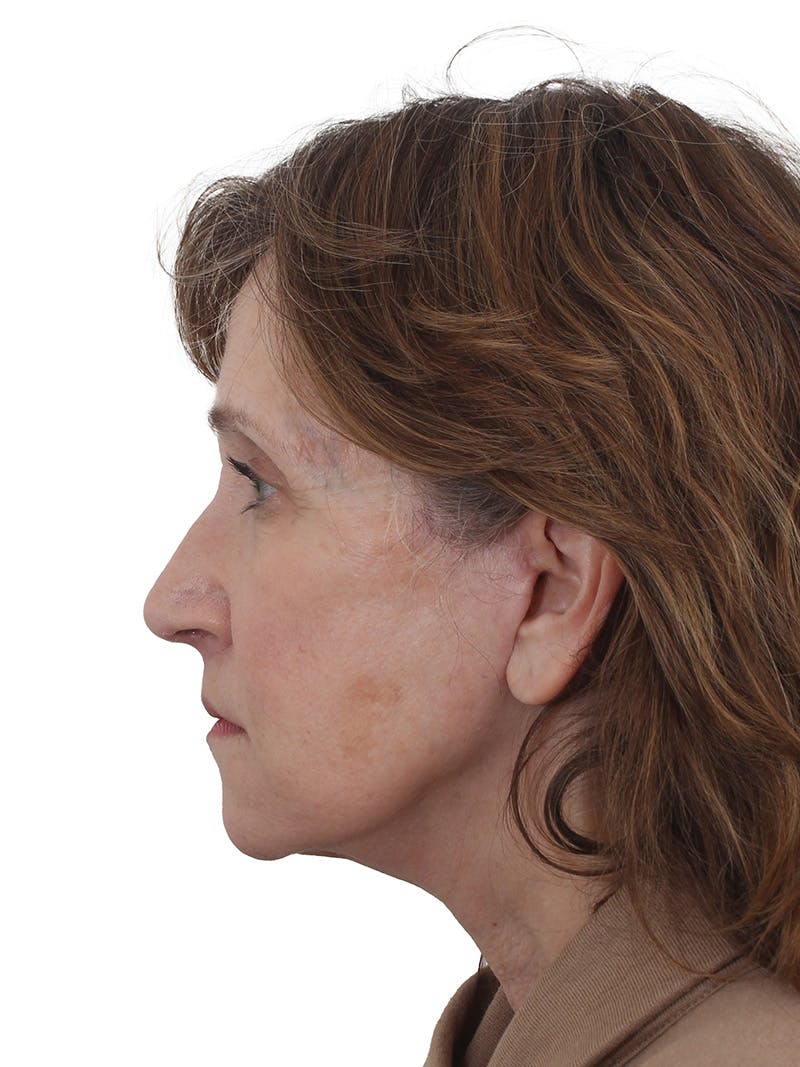 Fat Transfer Before & After Gallery - Patient 322455 - Image 6