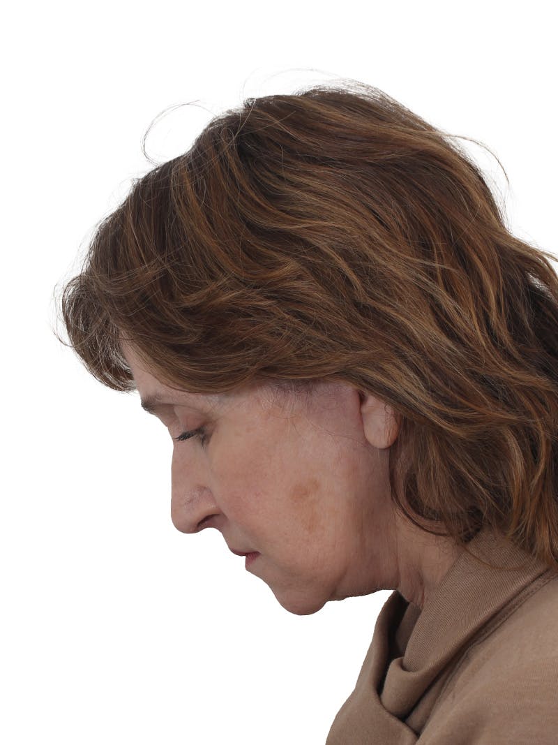Fat Transfer Before & After Gallery - Patient 322455 - Image 8