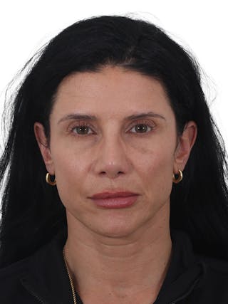 Fat Transfer Before & After Gallery - Patient 240191 - Image 2