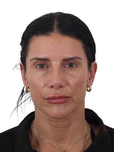 Fat Transfer Before & After Gallery - Patient 240191 - Image 1