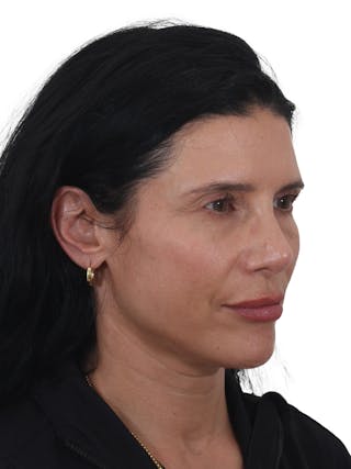 Fat Transfer Before & After Gallery - Patient 240191 - Image 4