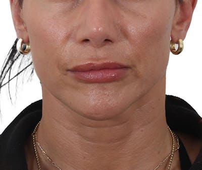 Buccal Fat Reduction Before & After Gallery - Patient 995129 - Image 1
