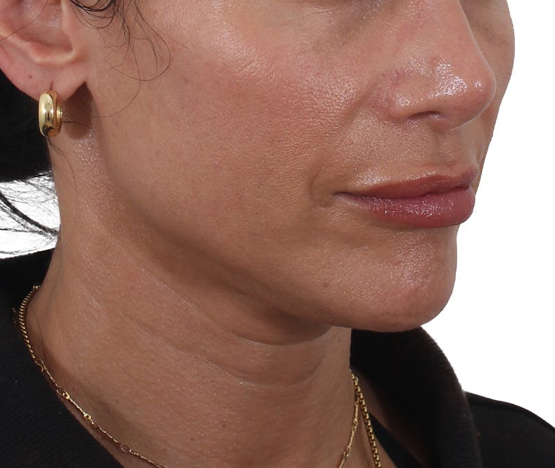 Buccal Fat Reduction Before & After Gallery - Patient 995129 - Image 3