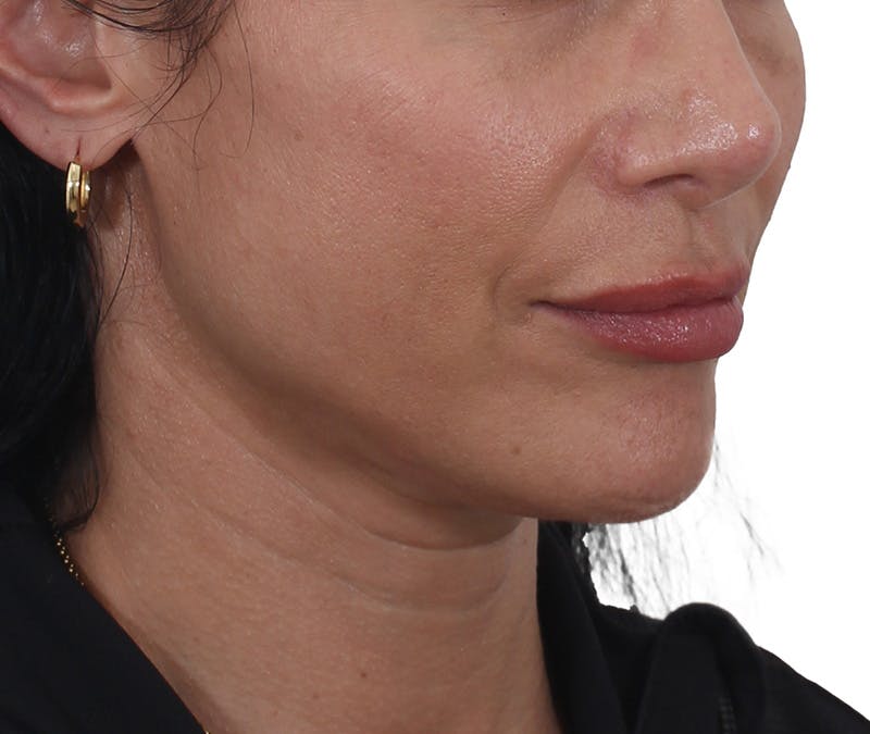Buccal Fat Reduction Before & After Gallery - Patient 995129 - Image 4