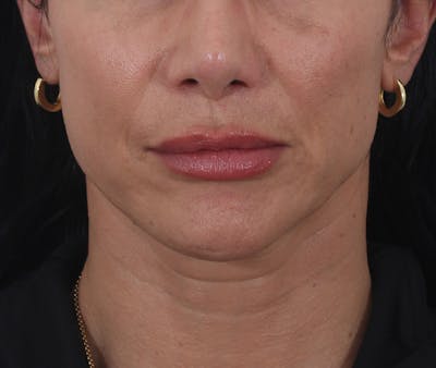 Buccal Fat Reduction Before & After Gallery - Patient 995129 - Image 2
