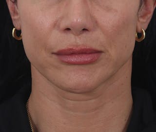 Buccal Fat Reduction Before & After Gallery - Patient 995129 - Image 2