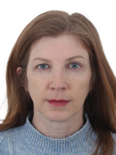 Blepharoplasty Before & After Gallery - Patient 330676 - Image 1