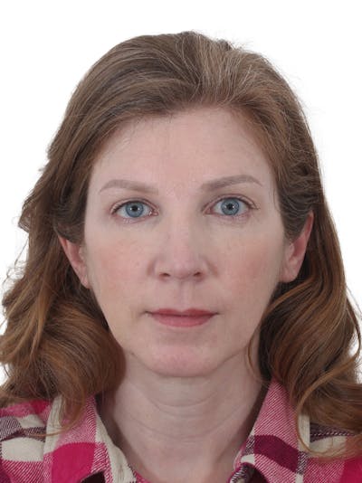 Blepharoplasty Before & After Gallery - Patient 330676 - Image 2