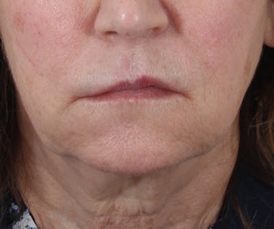 Lip Augmentation  Before & After Gallery - Patient 560858 - Image 1