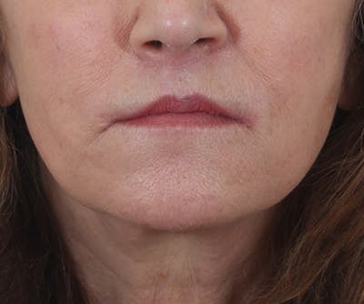 Lip Augmentation  Before & After Gallery - Patient 560858 - Image 2