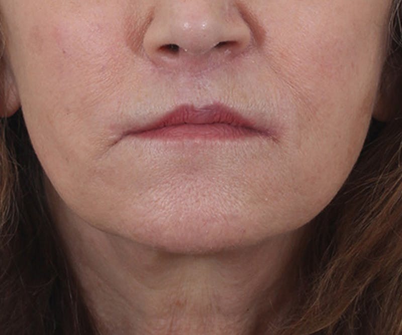 Lip Augmentation  Before & After Gallery - Patient 560858 - Image 2