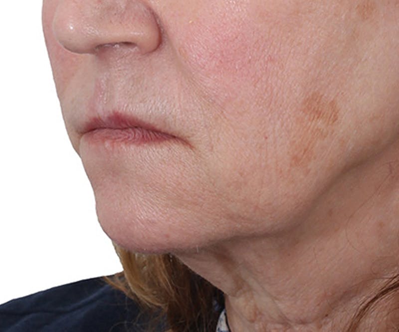 Lip Augmentation  Before & After Gallery - Patient 560858 - Image 3
