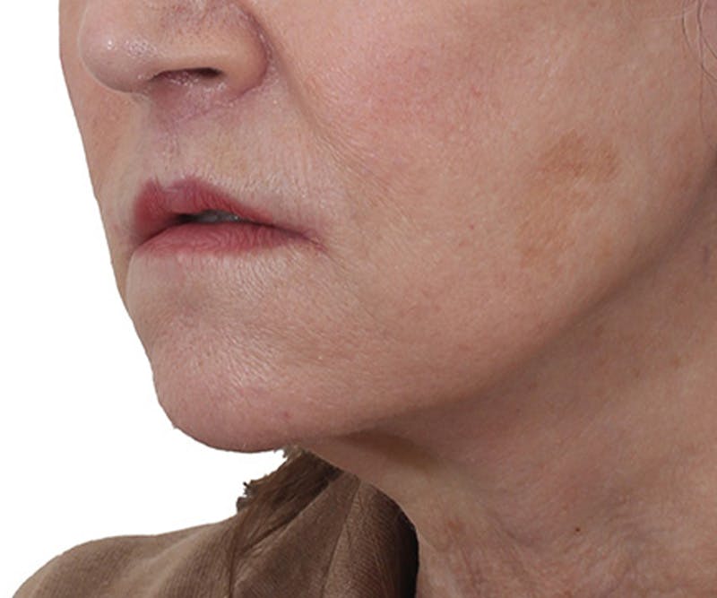 Lip Augmentation  Before & After Gallery - Patient 560858 - Image 4