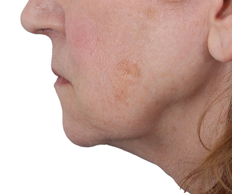 Lip Augmentation  Before & After Gallery - Patient 560858 - Image 5