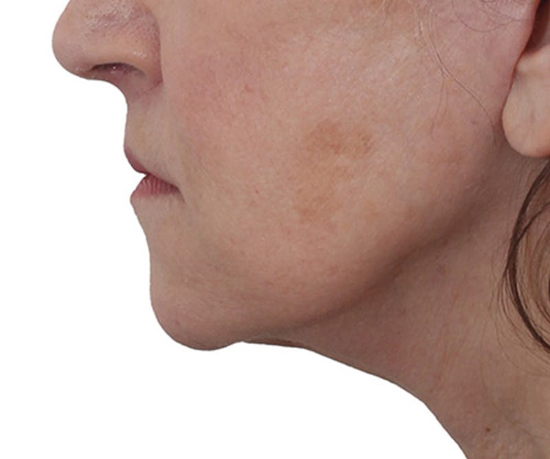 Lip Augmentation  Before & After Gallery - Patient 560858 - Image 6