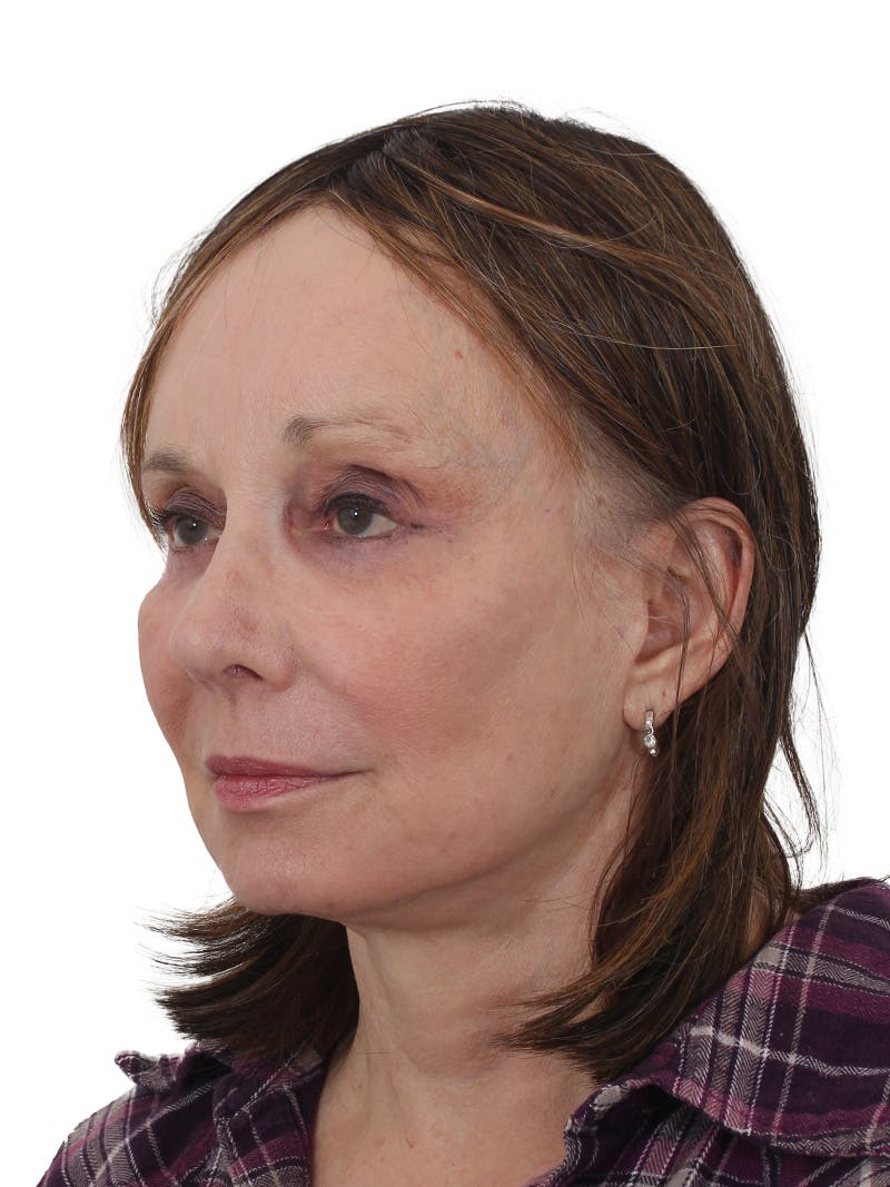 Dr. Frankel’s Facelift in Cleveland Before and After 13