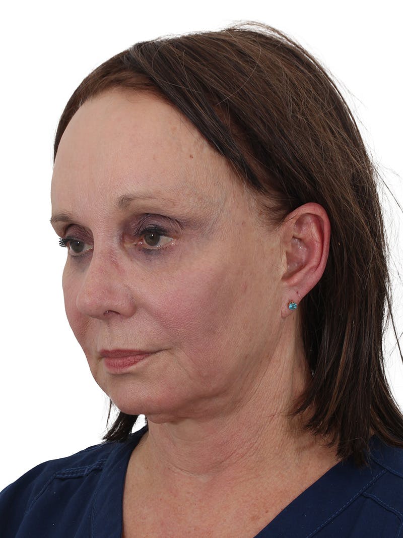 Dr. Frankel’s Facelift in Cleveland Before and After 13