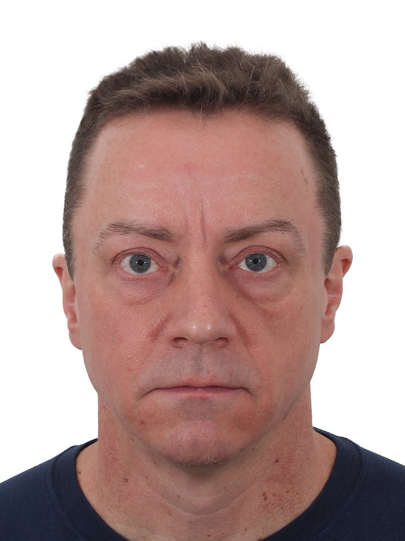 Laser Treatment Before & After Gallery - Patient 246672 - Image 1