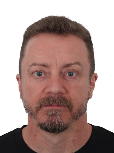 Laser Treatment Before & After Gallery - Patient 246672 - Image 2