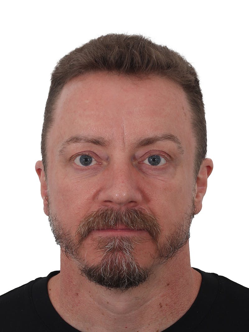 Laser Treatment Before & After Gallery - Patient 246672 - Image 2