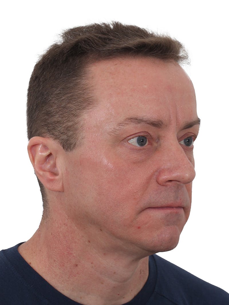 Laser Treatment Before & After Gallery - Patient 246672 - Image 3