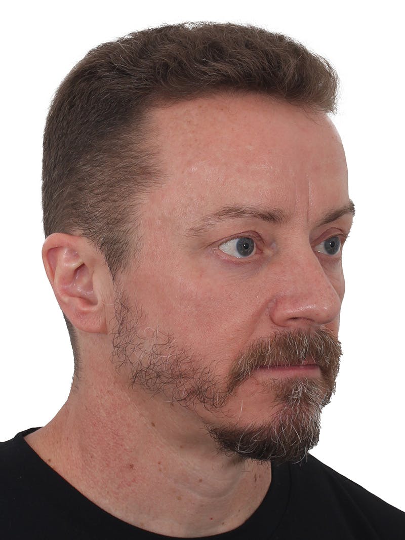 Laser Treatment Before & After Gallery - Patient 246672 - Image 4