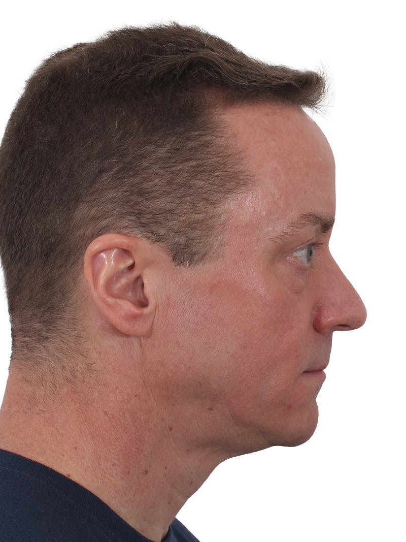 Laser Treatment Before & After Gallery - Patient 246672 - Image 5