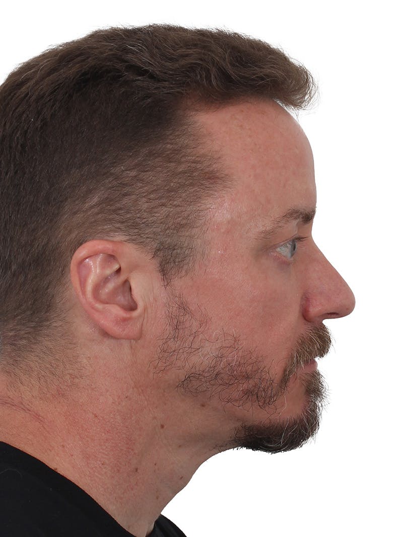 Laser Treatment Before & After Gallery - Patient 246672 - Image 6