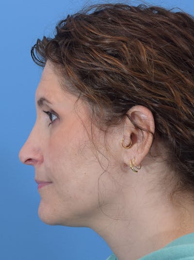 Rhinoplasty Before & After Gallery - Patient 345070 - Image 2
