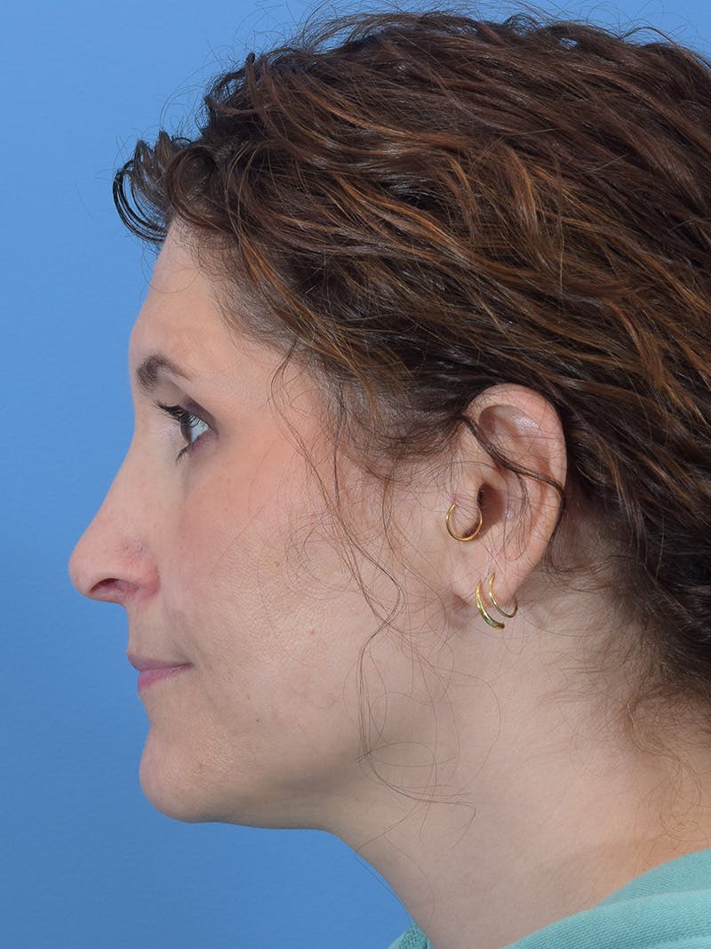 Rhinoplasty Before & After Gallery - Patient 345070 - Image 2