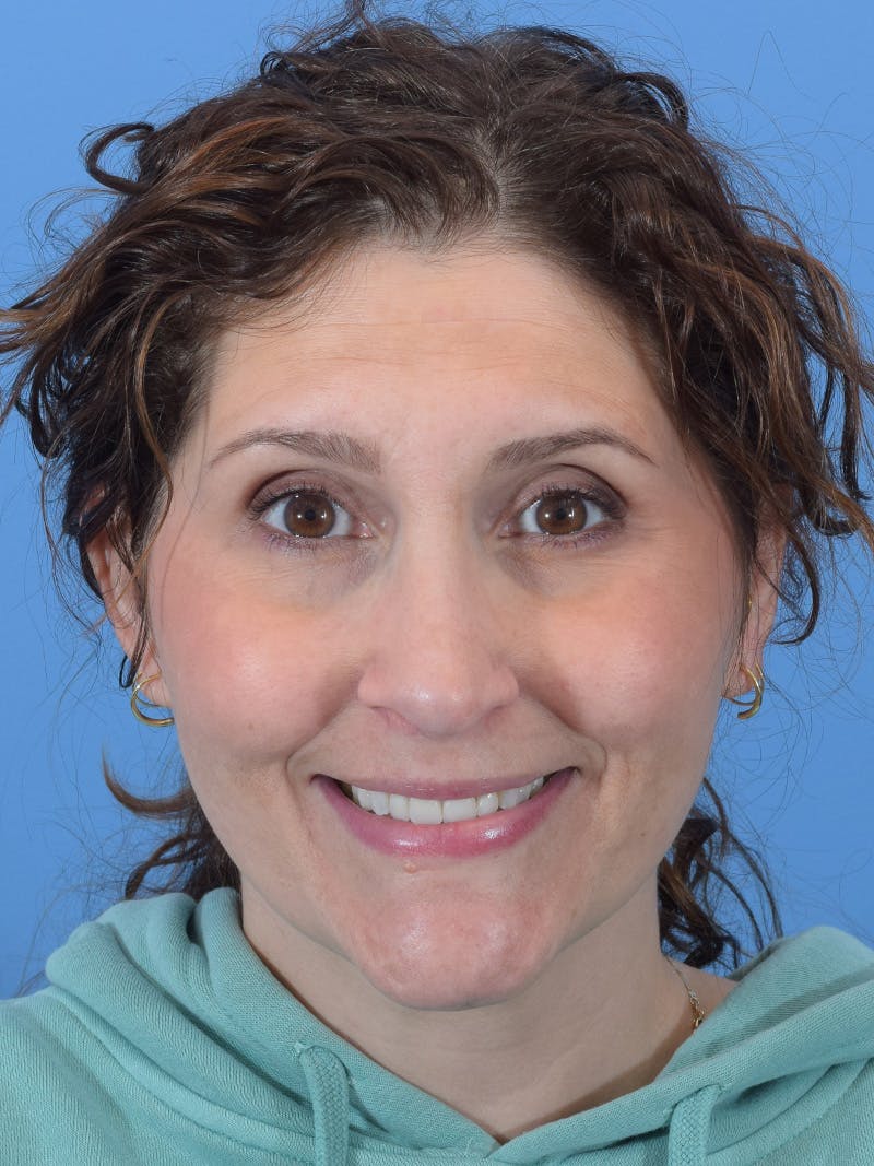 Rhinoplasty Before & After Gallery - Patient 345070 - Image 6