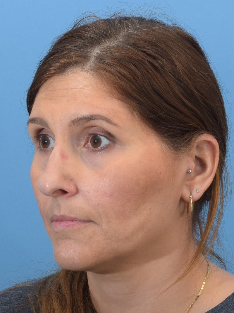 Rhinoplasty Before & After Gallery - Patient 345070 - Image 3