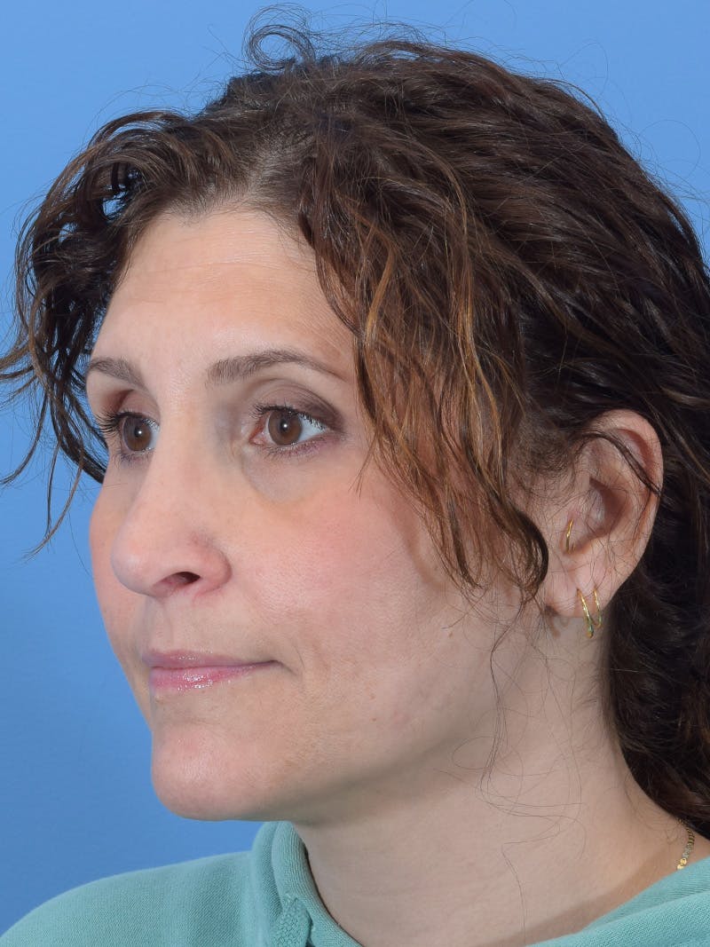 Rhinoplasty Before & After Gallery - Patient 345070 - Image 4