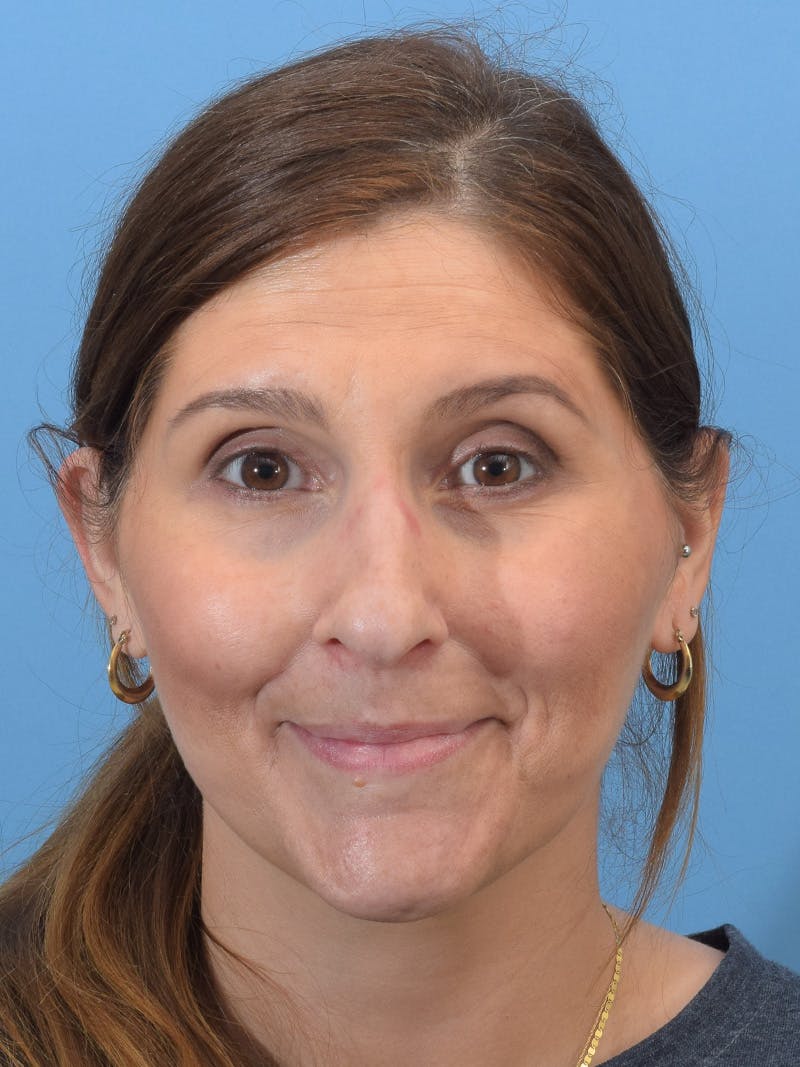 Rhinoplasty Before & After Gallery - Patient 345070 - Image 5