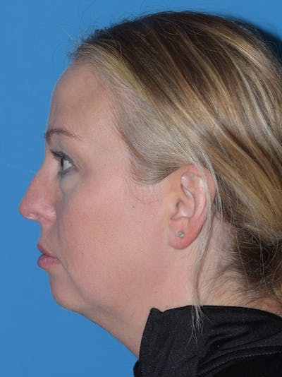 Rhinoplasty Before & After Gallery - Patient 408011 - Image 1