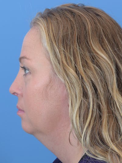 Rhinoplasty Before & After Gallery - Patient 408011 - Image 2