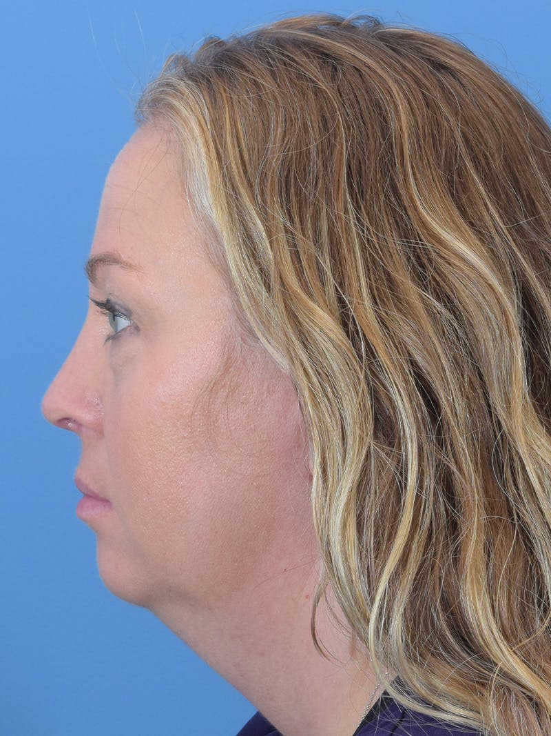 Rhinoplasty Before & After Gallery - Patient 408011 - Image 2