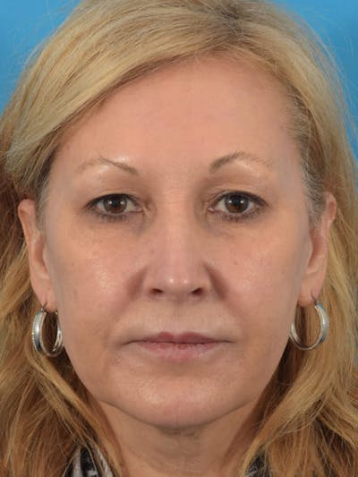 Laser Treatment Before & After Gallery - Patient 40749736 - Image 1