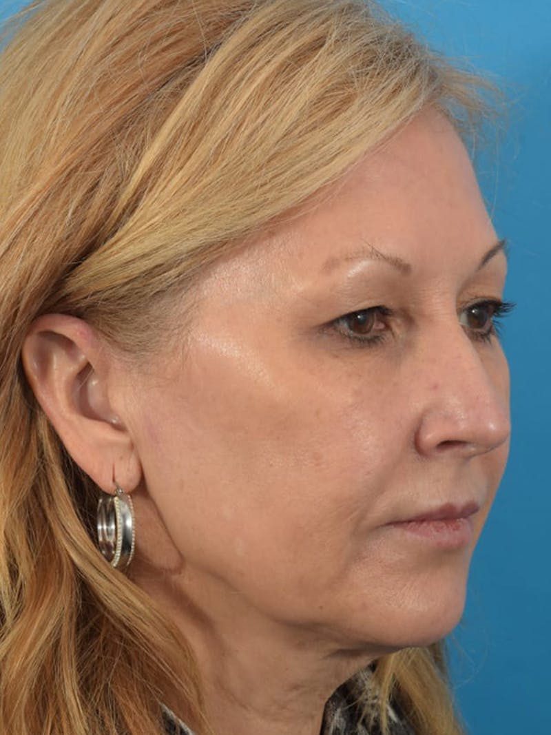 Laser Treatment Before & After Gallery - Patient 40749736 - Image 3