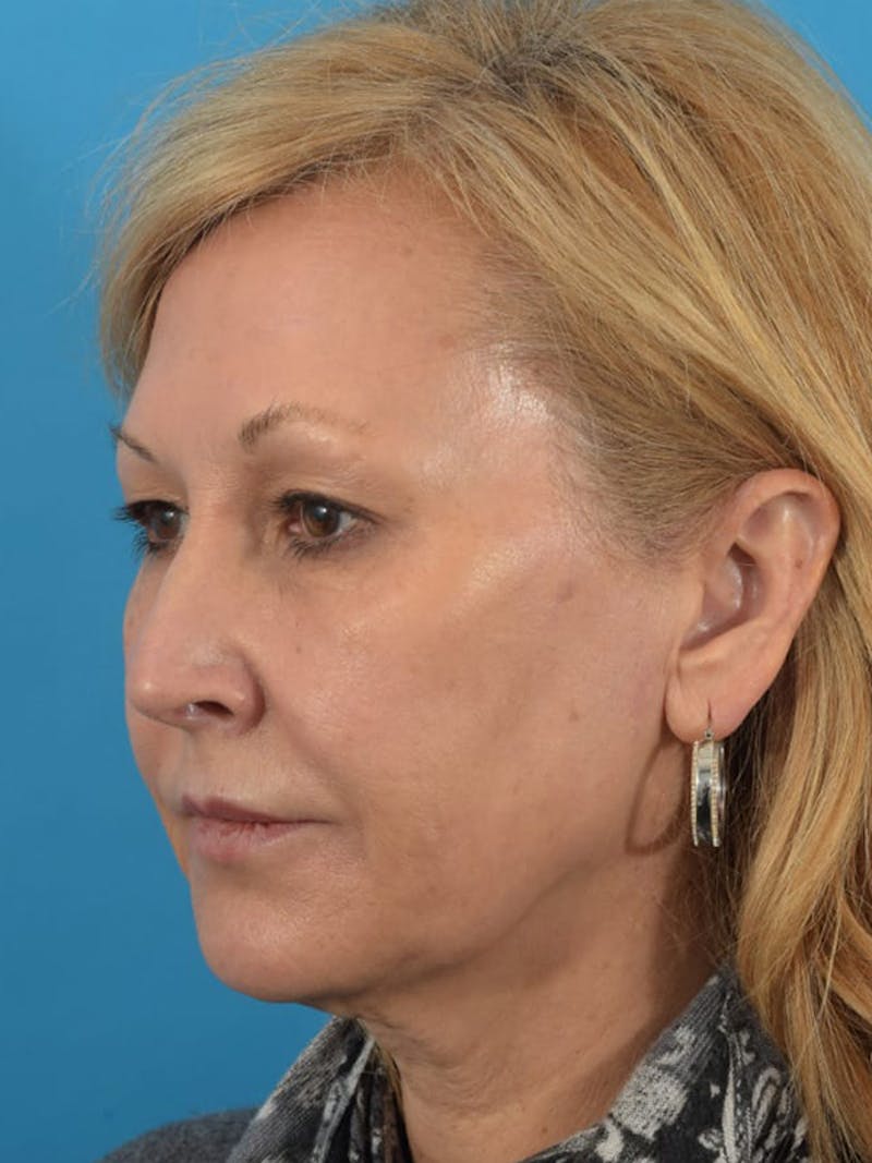 Laser Treatment Before & After Gallery - Patient 40749736 - Image 7