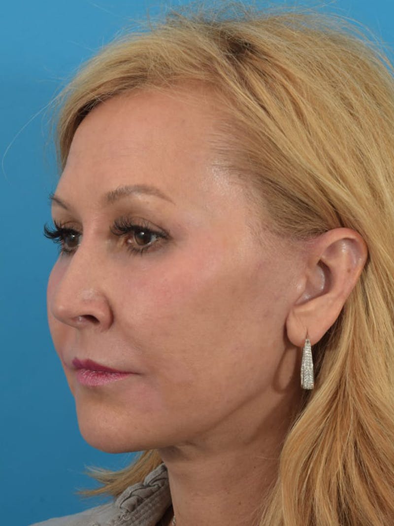 Laser Treatment Before & After Gallery - Patient 40749736 - Image 8