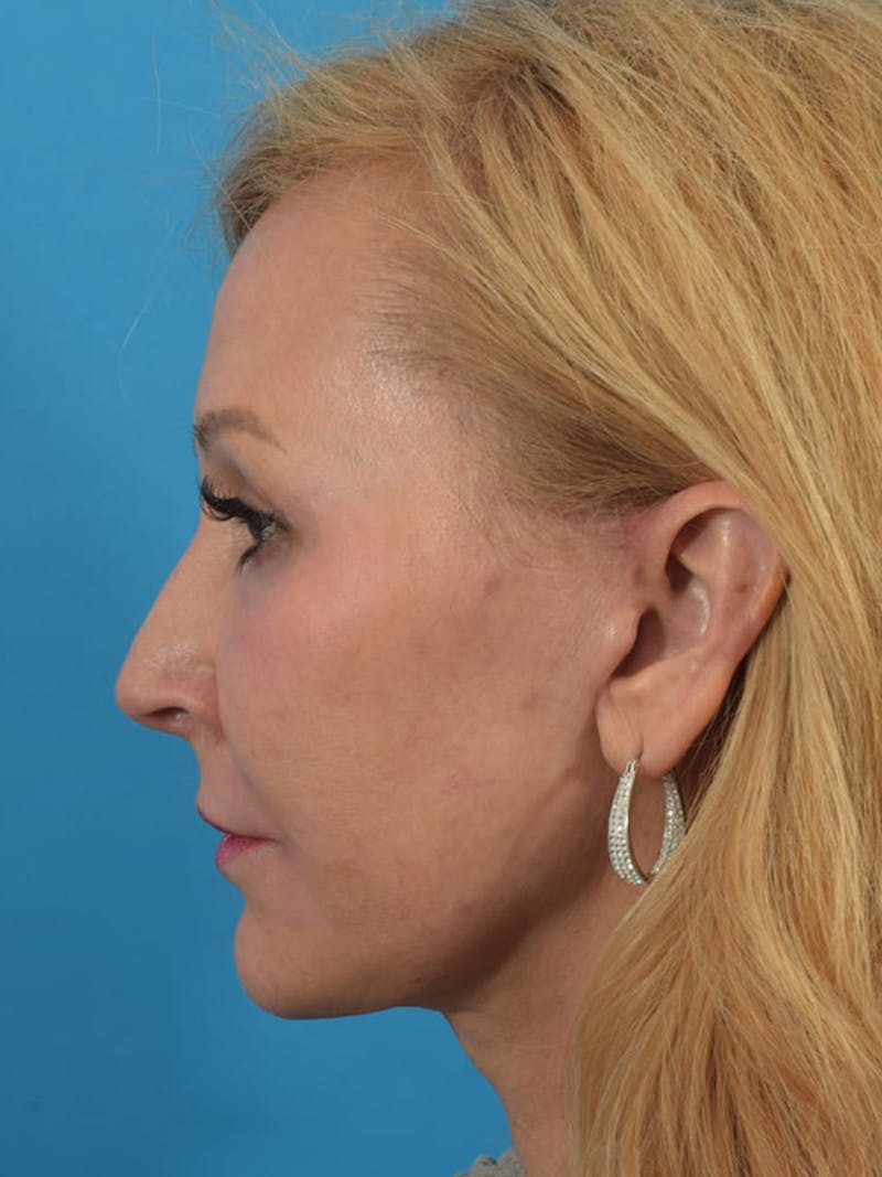 Laser Treatment Before & After Gallery - Patient 40749736 - Image 10