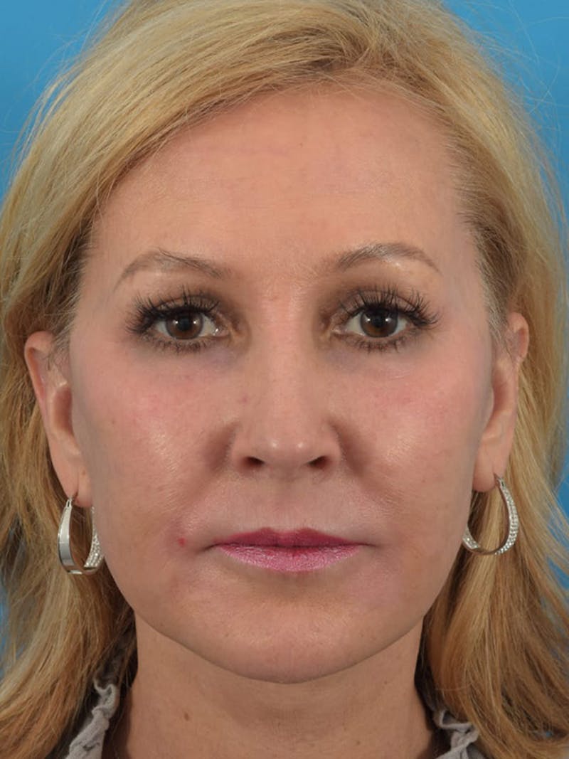 Laser Treatment Before & After Gallery - Patient 40749736 - Image 2